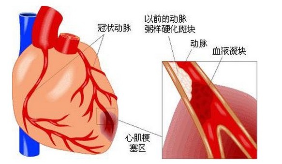 临床医学图库:急性心肌梗死 血栓形成过程图
