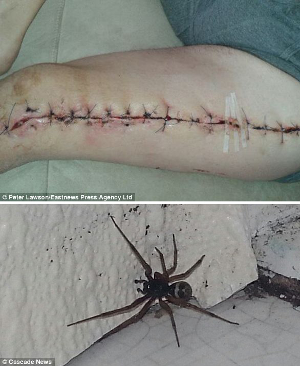 英国工人被假寡妇蜘蛛咬到差点失去一条腿