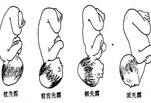 胎先露的分类执业护士考试妇产科护理学指导