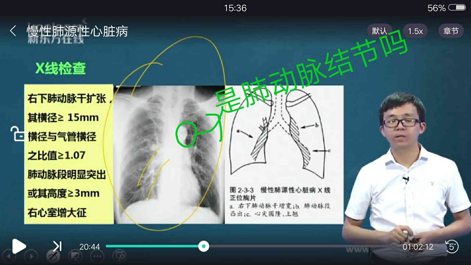 主动脉结小图片